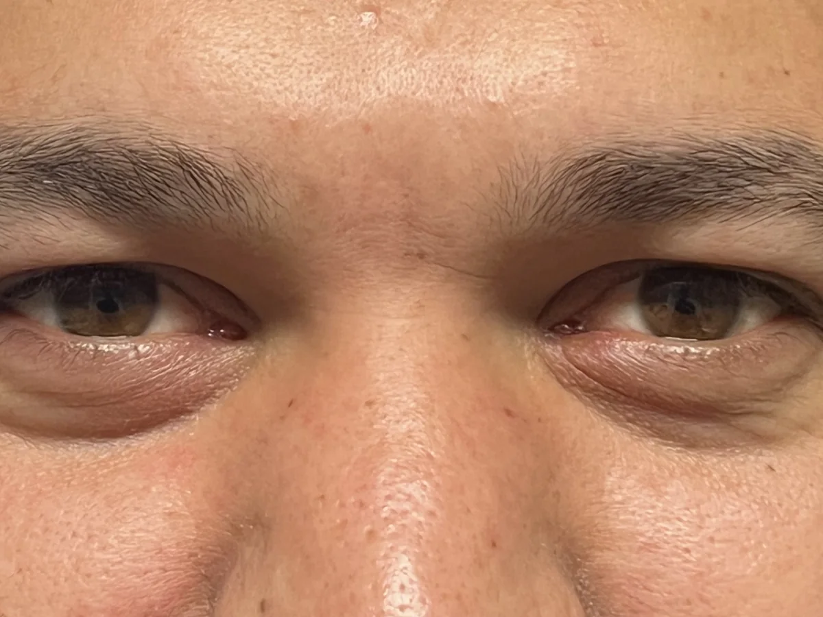 After Traumatic Lacerations to the Eyelid and Tear Duct — patient of Dr. Ahmed Sheikh, Morristown NJ
