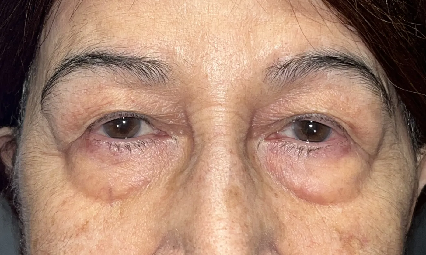 Before Upper Blepharoplasty · Ptosis Repair — patient photo