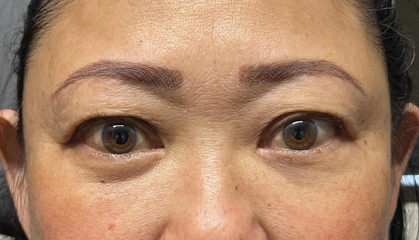 After Orbital Fracture Repair — patient photo
