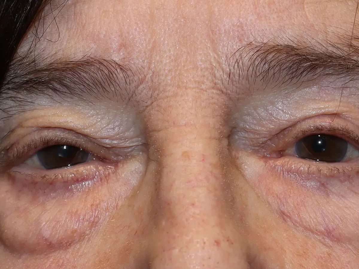 Before Lower Blepharoplasty — patient of Dr. Ahmed Sheikh, Morristown NJ