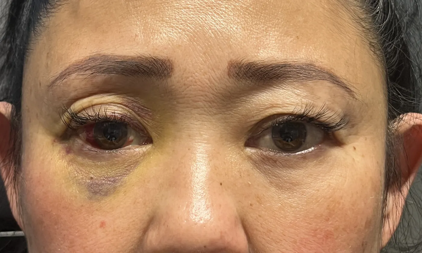 Before Orbital Fracture Repair — patient photo