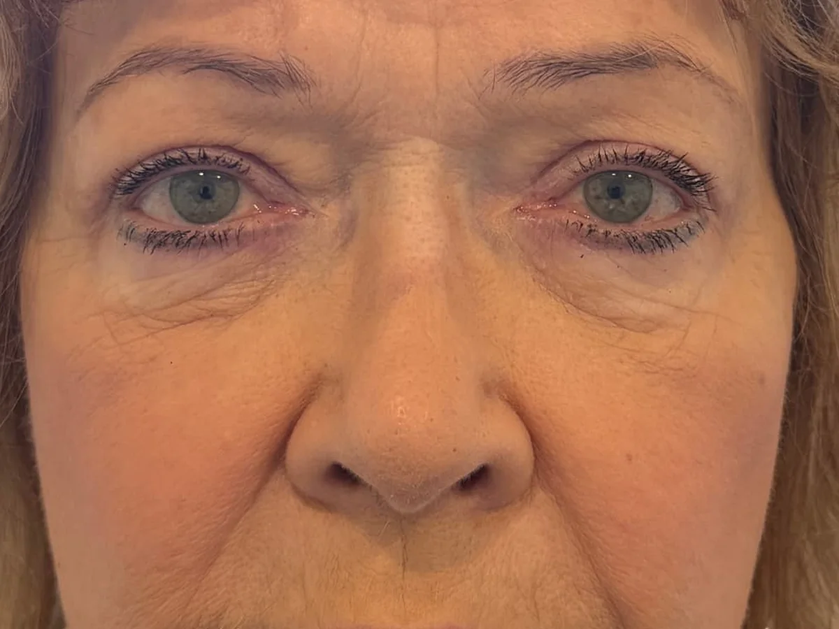 After Upper Blepharoplasty · Brow Lift — patient of Dr. Ahmed Sheikh, Morristown NJ