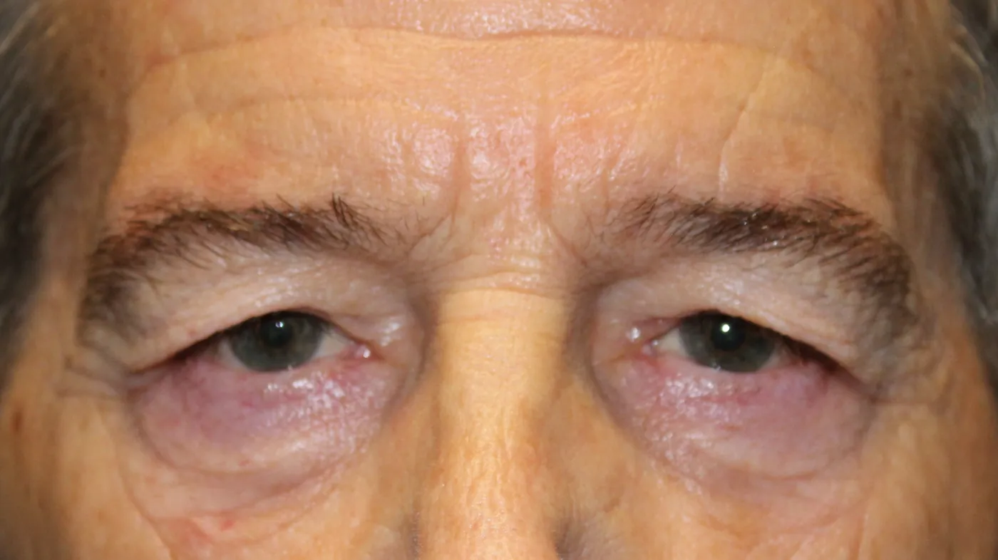 Before Upper Blepharoplasty · Brow Lift — patient photo