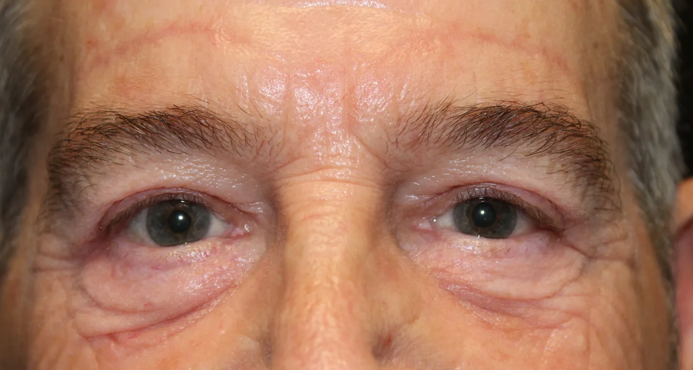 After Upper Blepharoplasty · Brow Lift — patient photo