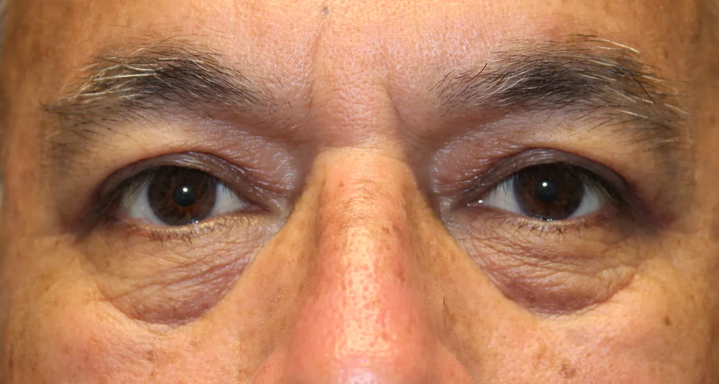 After Upper Blepharoplasty — patient photo