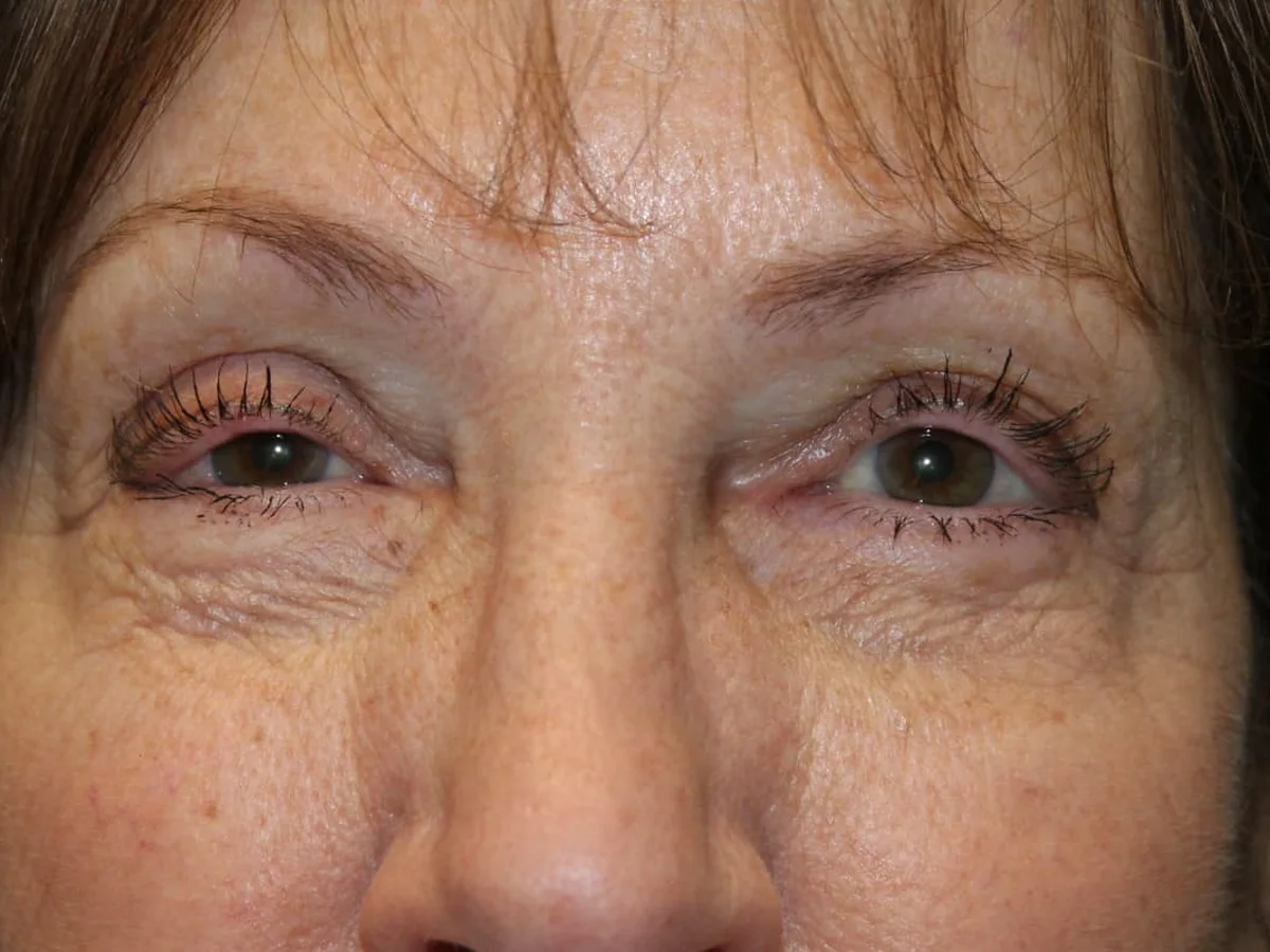 Before Ptosis Repair · Upper Blepharoplasty — patient of Dr. Ahmed Sheikh, Morristown NJ