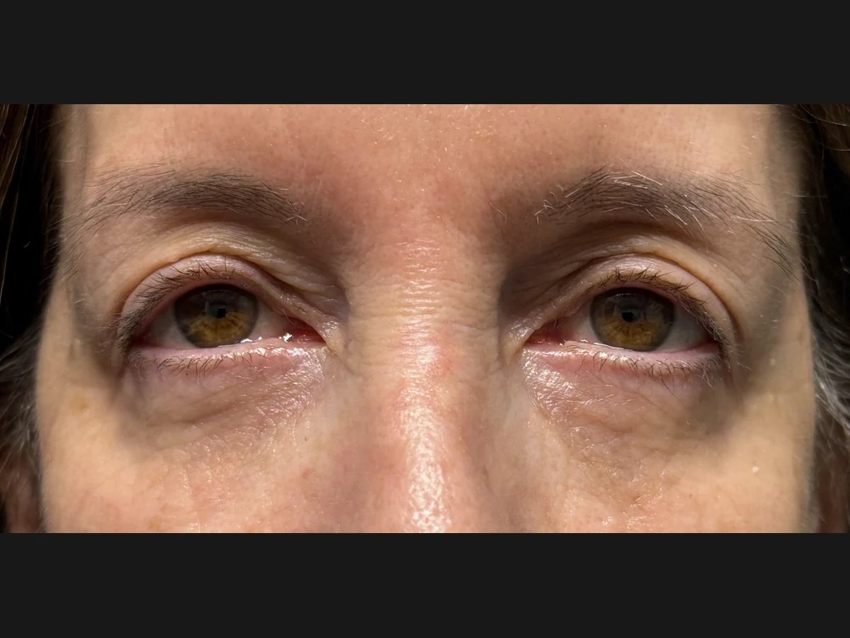 After Upper Blepharoplasty · Ptosis Repair · Lower Blepharoplasty — patient of Dr. Ahmed Sheikh, Morristown NJ