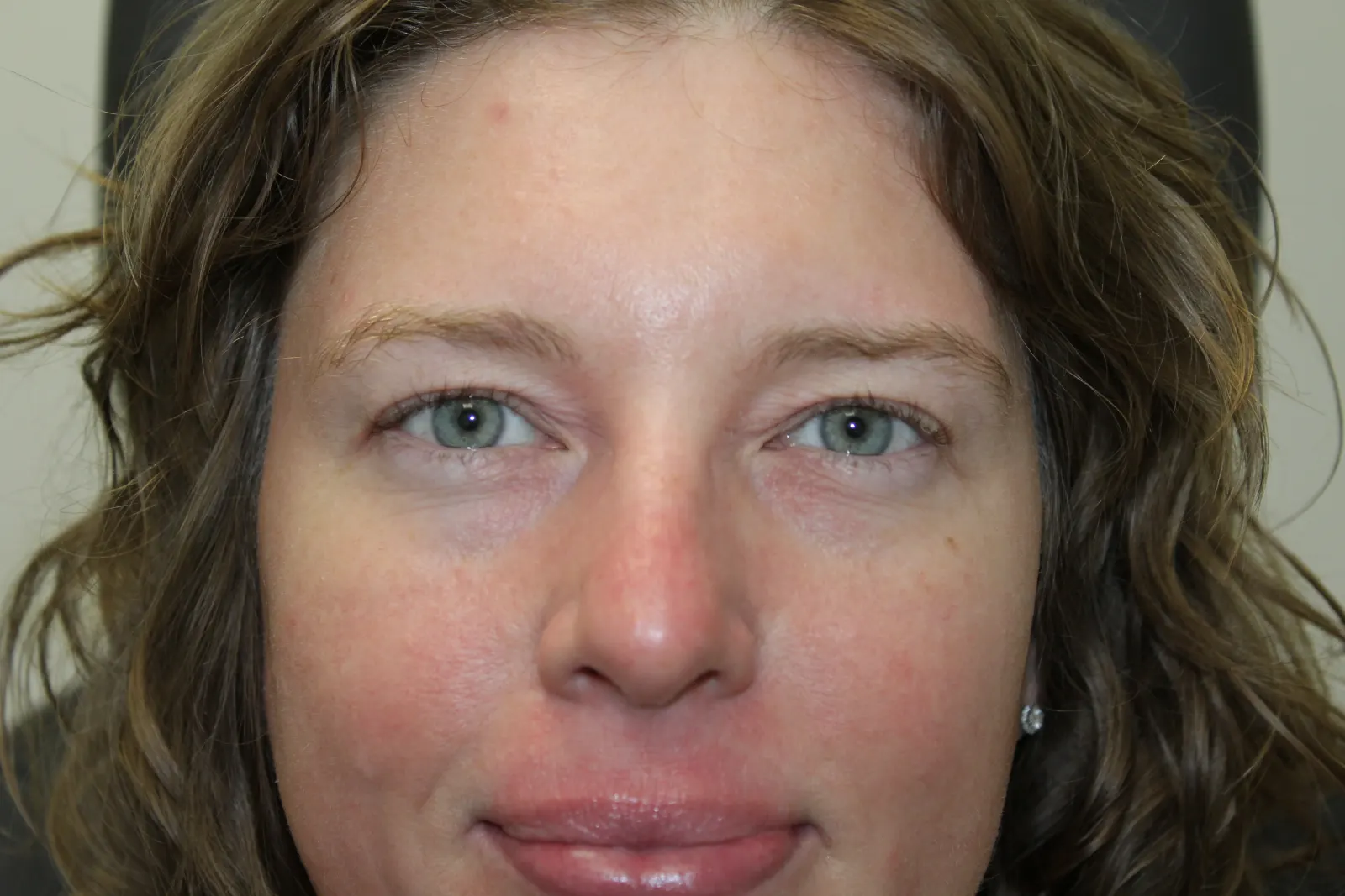 After Upper Blepharoplasty — patient photo