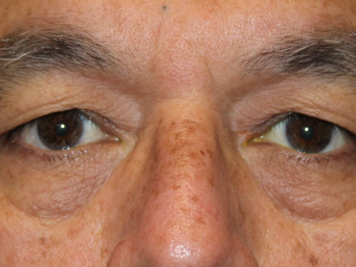 Before Upper Blepharoplasty — patient of Dr. Ahmed Sheikh, Morristown NJ