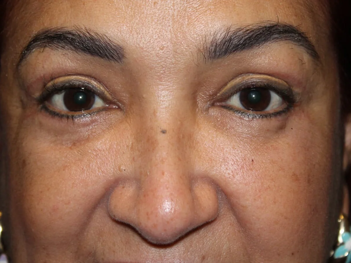 After Upper Blepharoplasty · Lower Blepharoplasty — patient of Dr. Ahmed Sheikh, Morristown NJ