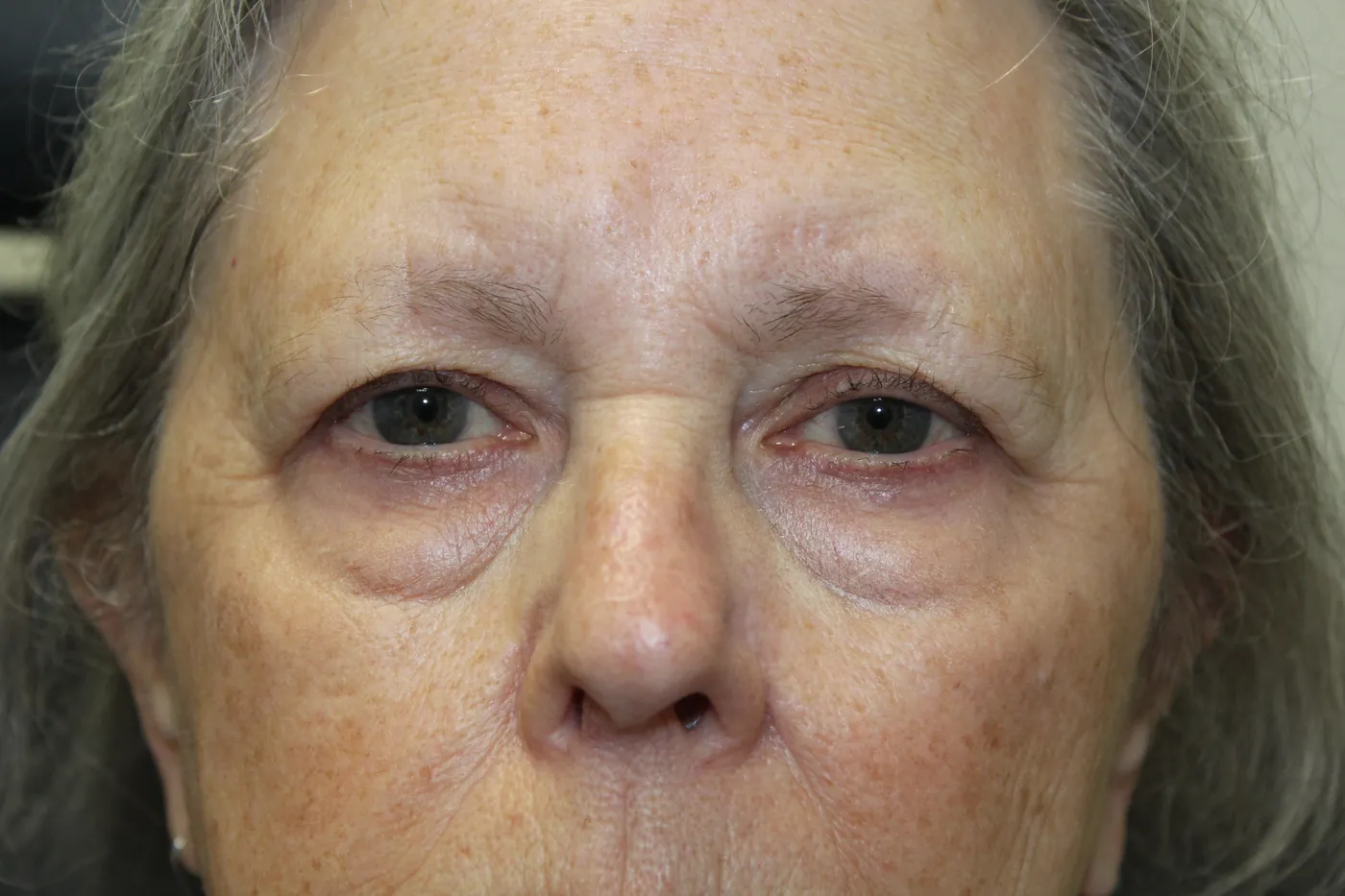Before Lateral Brow Lift · Upper Blepharoplasty · Ptosis Repair · Lower Blepharoplasty — patient photo