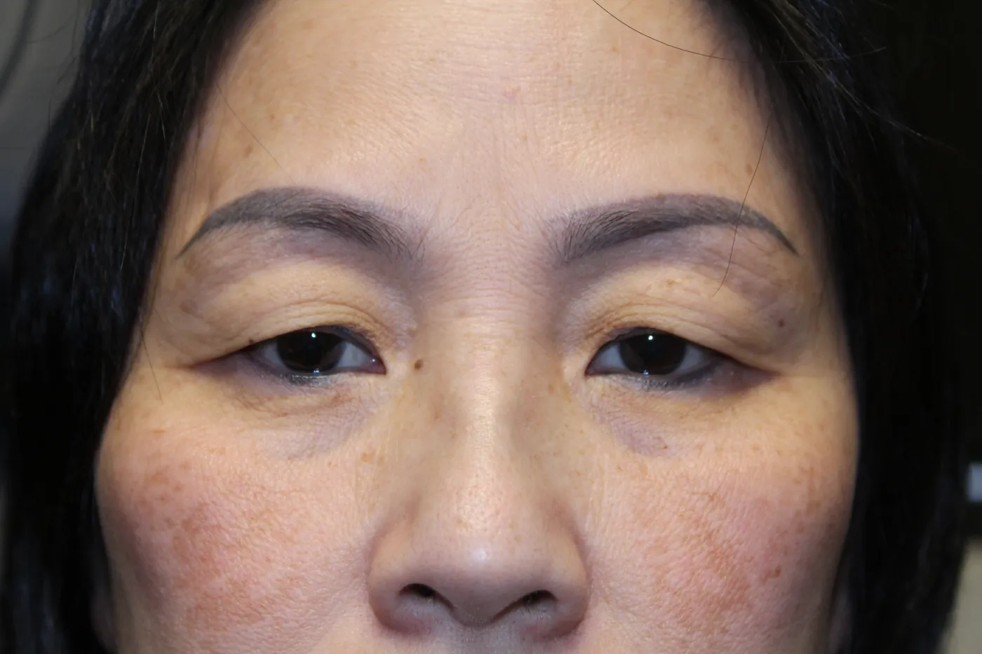 Before Upper Blepharoplasty — patient photo