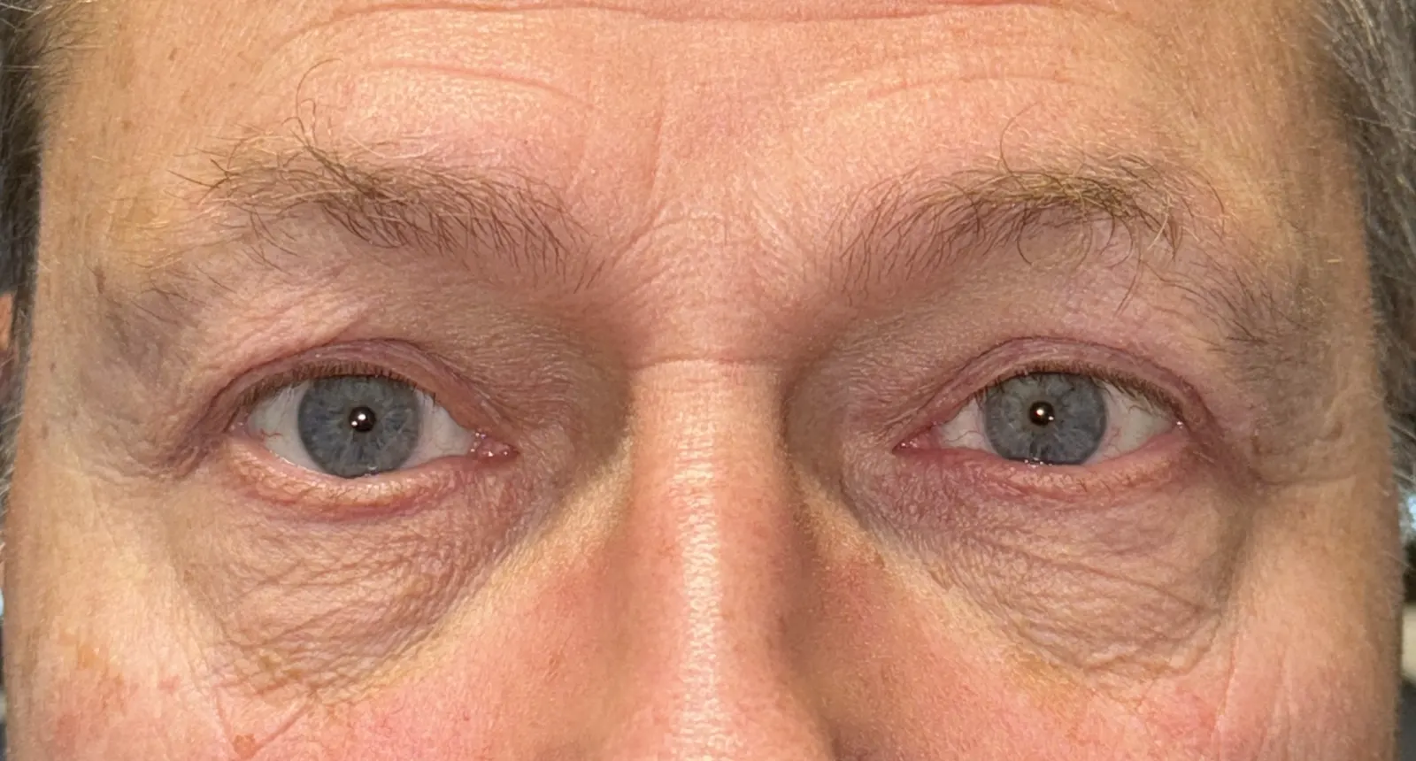 After Upper Blepharoplasty — patient photo