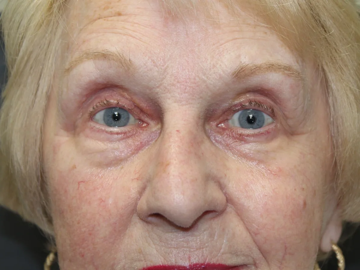 After Ptosis Repair — patient of Dr. Ahmed Sheikh, Morristown NJ