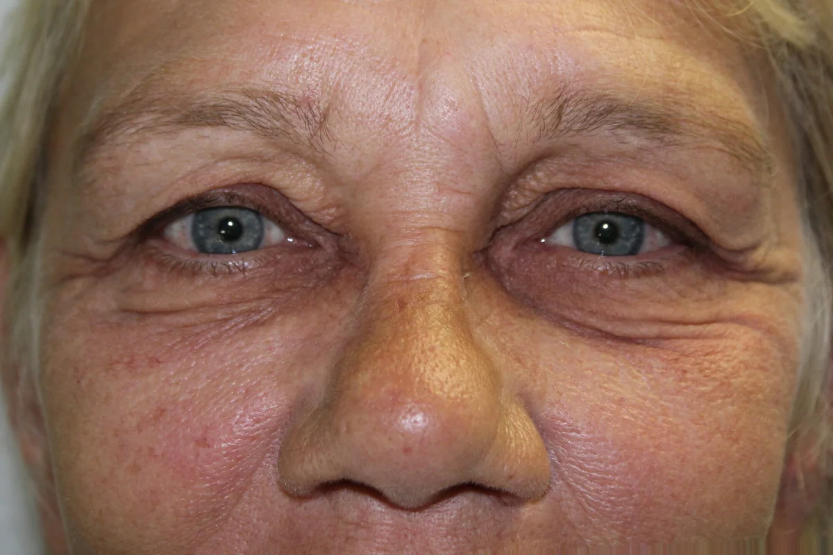 Before Brow Lift · Upper Blepharoplasty — patient photo