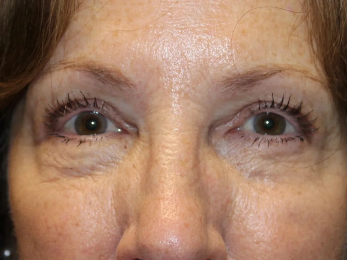 After Ptosis Repair · Upper Blepharoplasty — patient of Dr. Ahmed Sheikh, Morristown NJ