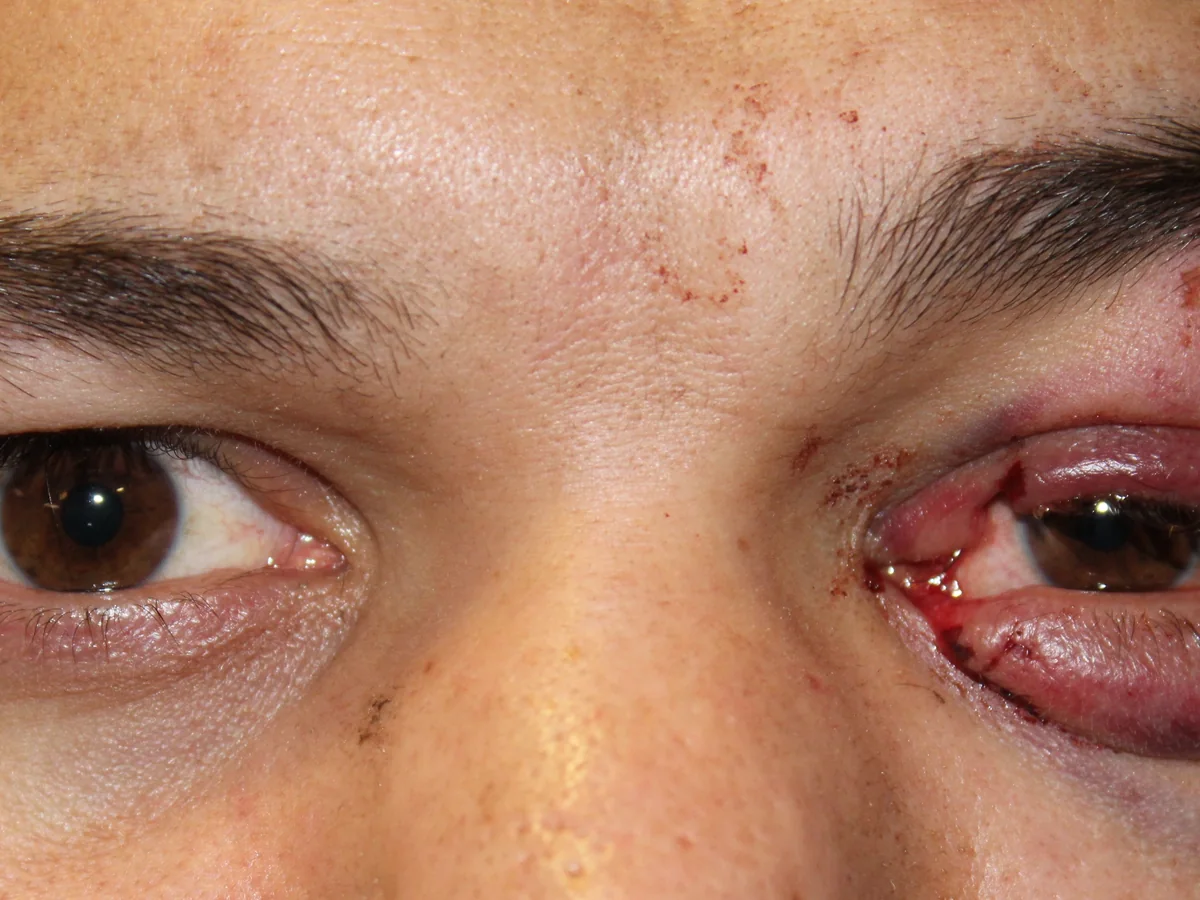 Before Traumatic Lacerations to the Eyelid and Tear Duct — patient of Dr. Ahmed Sheikh, Morristown NJ