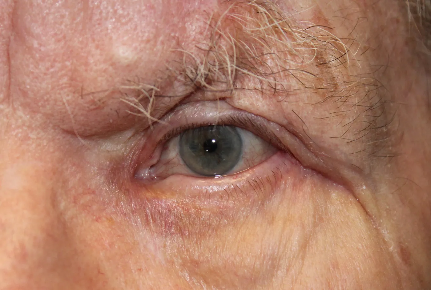 After Correction of a Paralyzed Lower Eyelid Using a Tendon Graft — patient photo