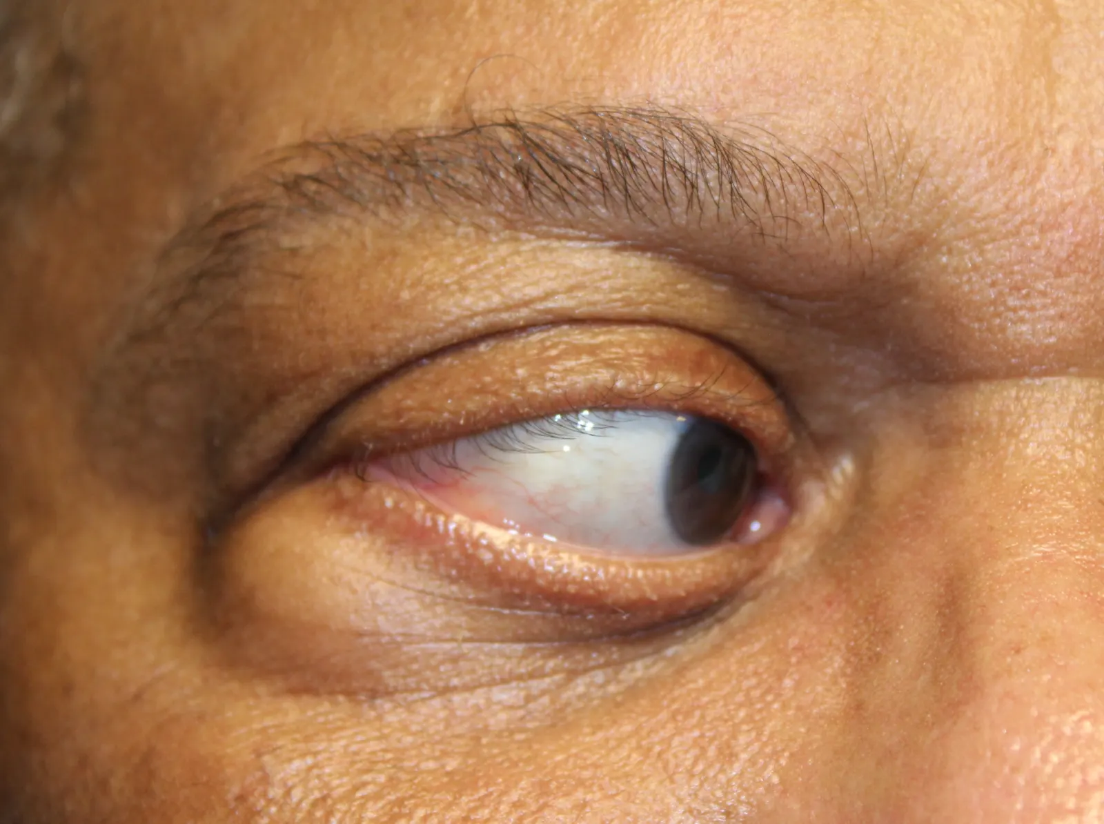 After Removal of Prolapsed Orbital Fat — patient photo