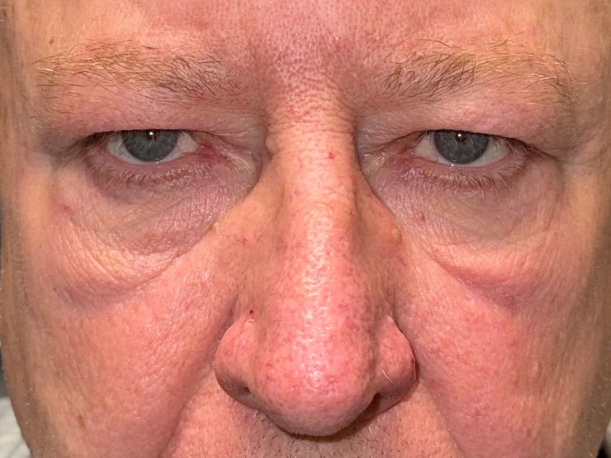 Before Brow Lift · Lower Blepharoplasty — patient of Dr. Ahmed Sheikh, Morristown NJ