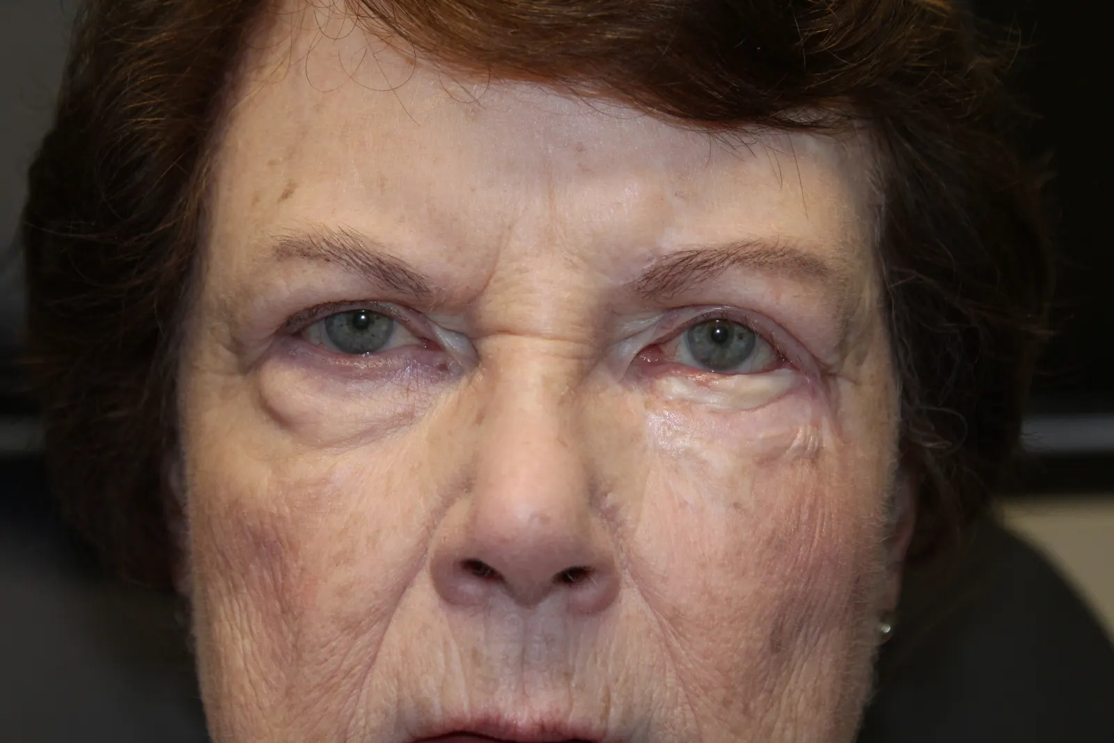 After Left Lower Eyelid Reconstruction — patient photo