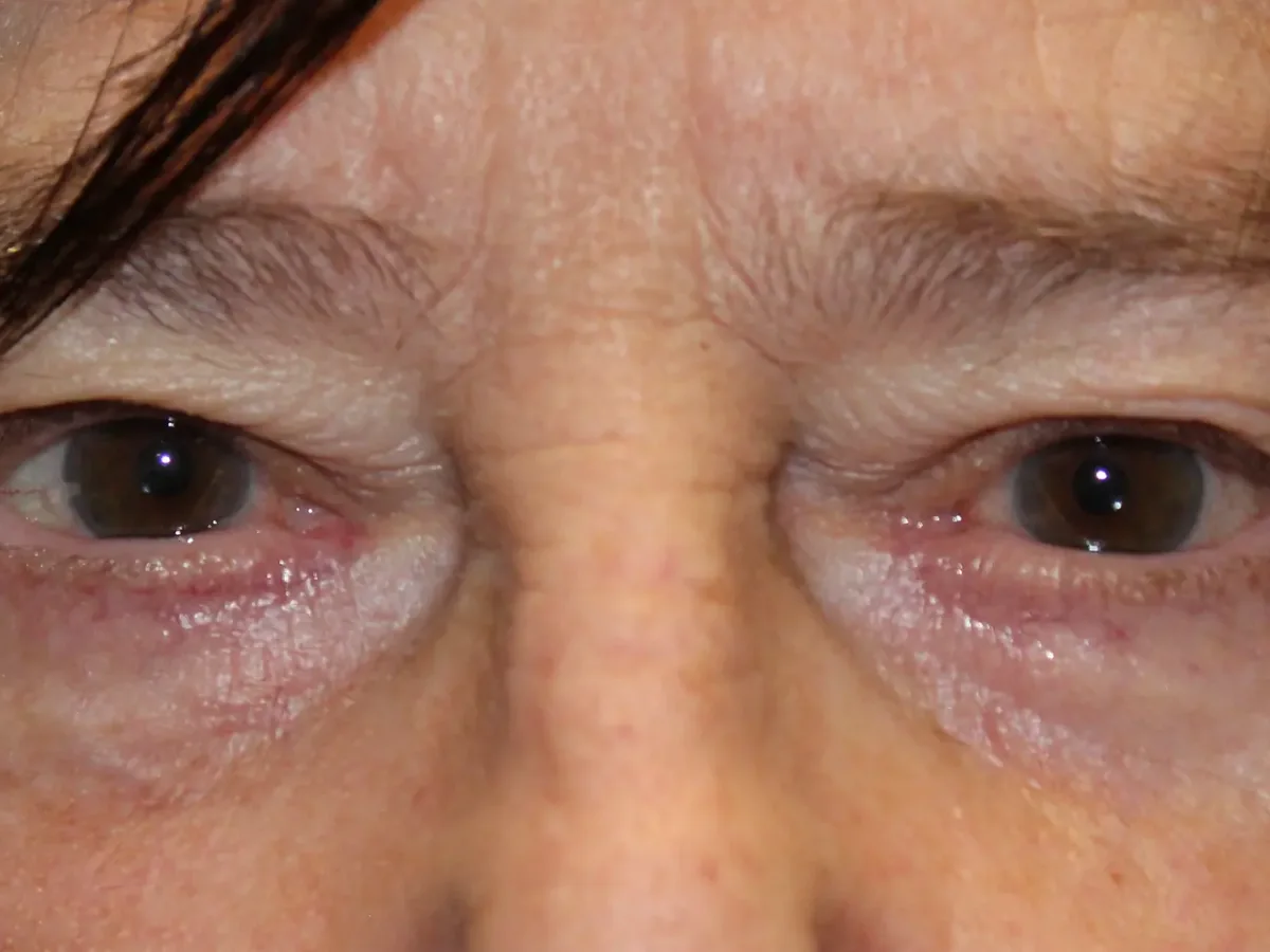 After Lower Blepharoplasty — patient of Dr. Ahmed Sheikh, Morristown NJ