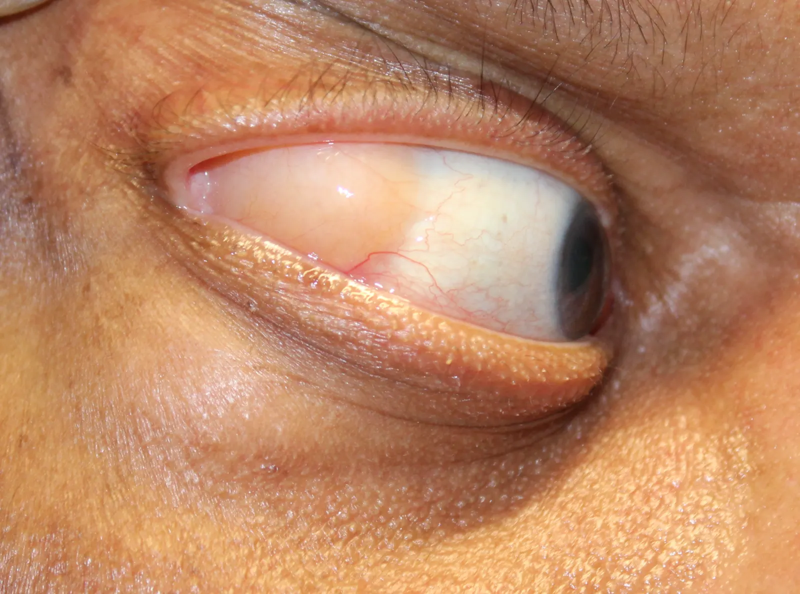 Before Removal of Prolapsed Orbital Fat — patient photo