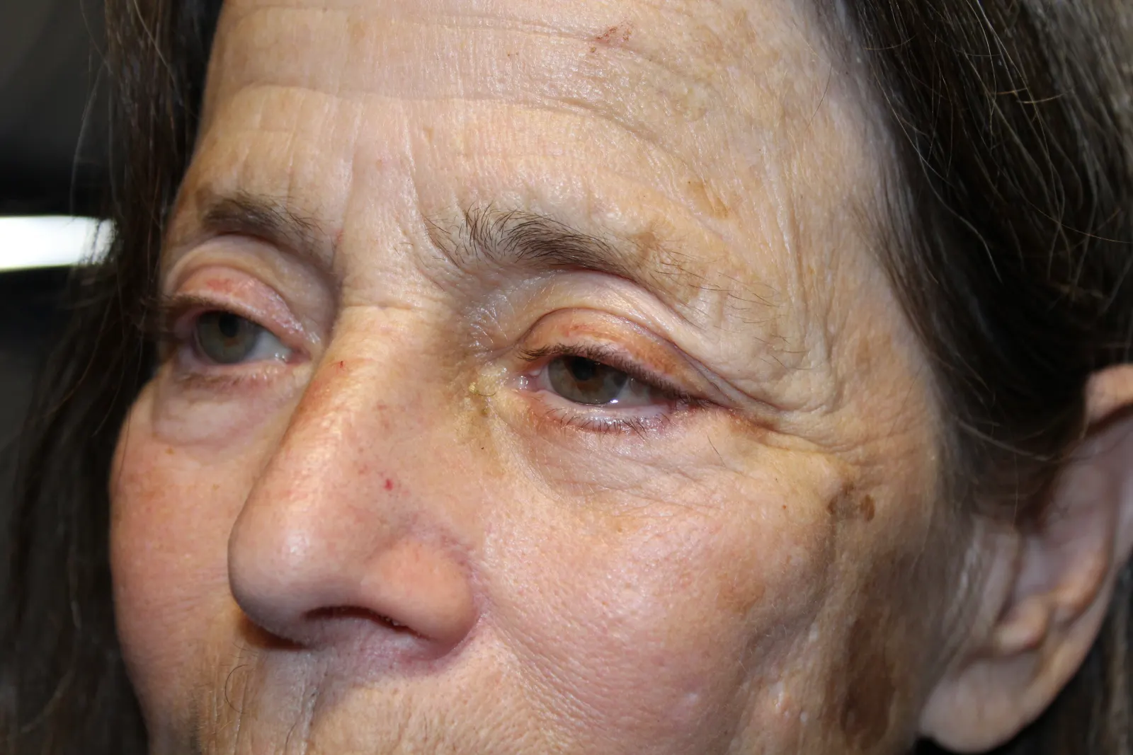 After Left Lower Eyelid Entropion Repair — patient photo