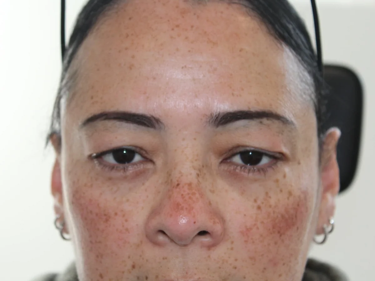 Before Upper Blepharoplasty — patient photo