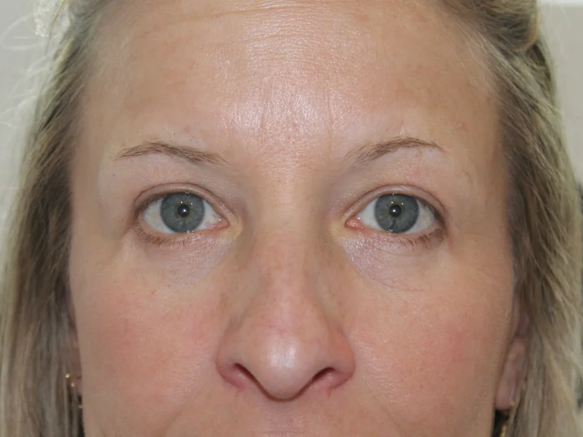 After Upper and Lower Blepharoplasty — patient photo