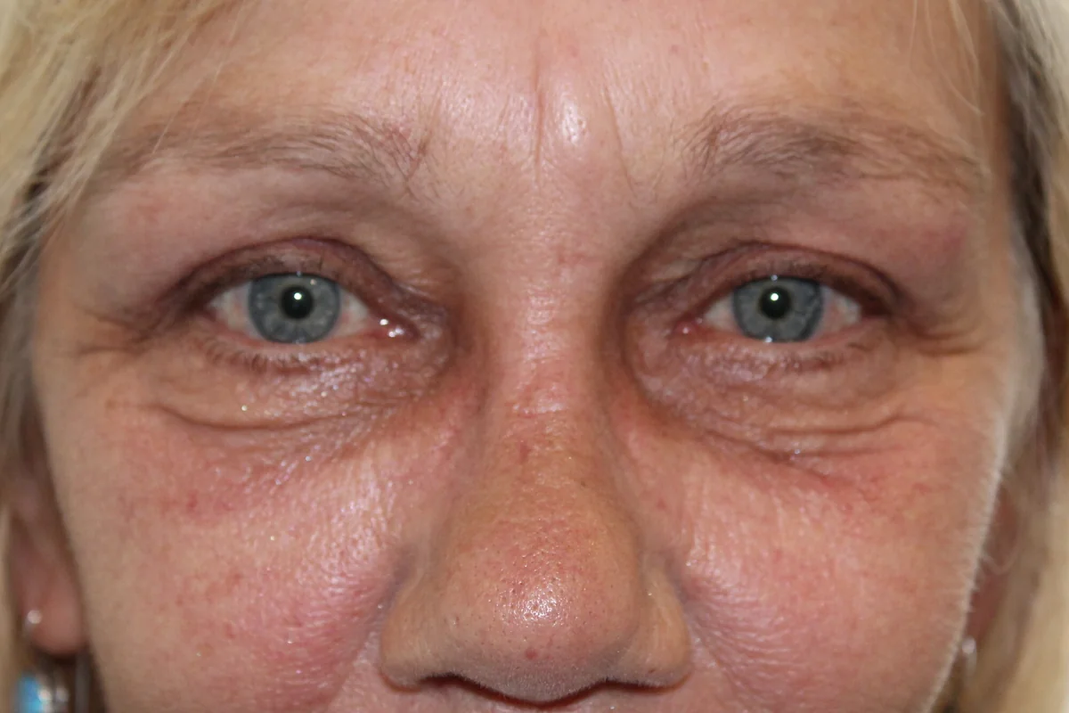 After Brow Lift · Upper Blepharoplasty — patient photo
