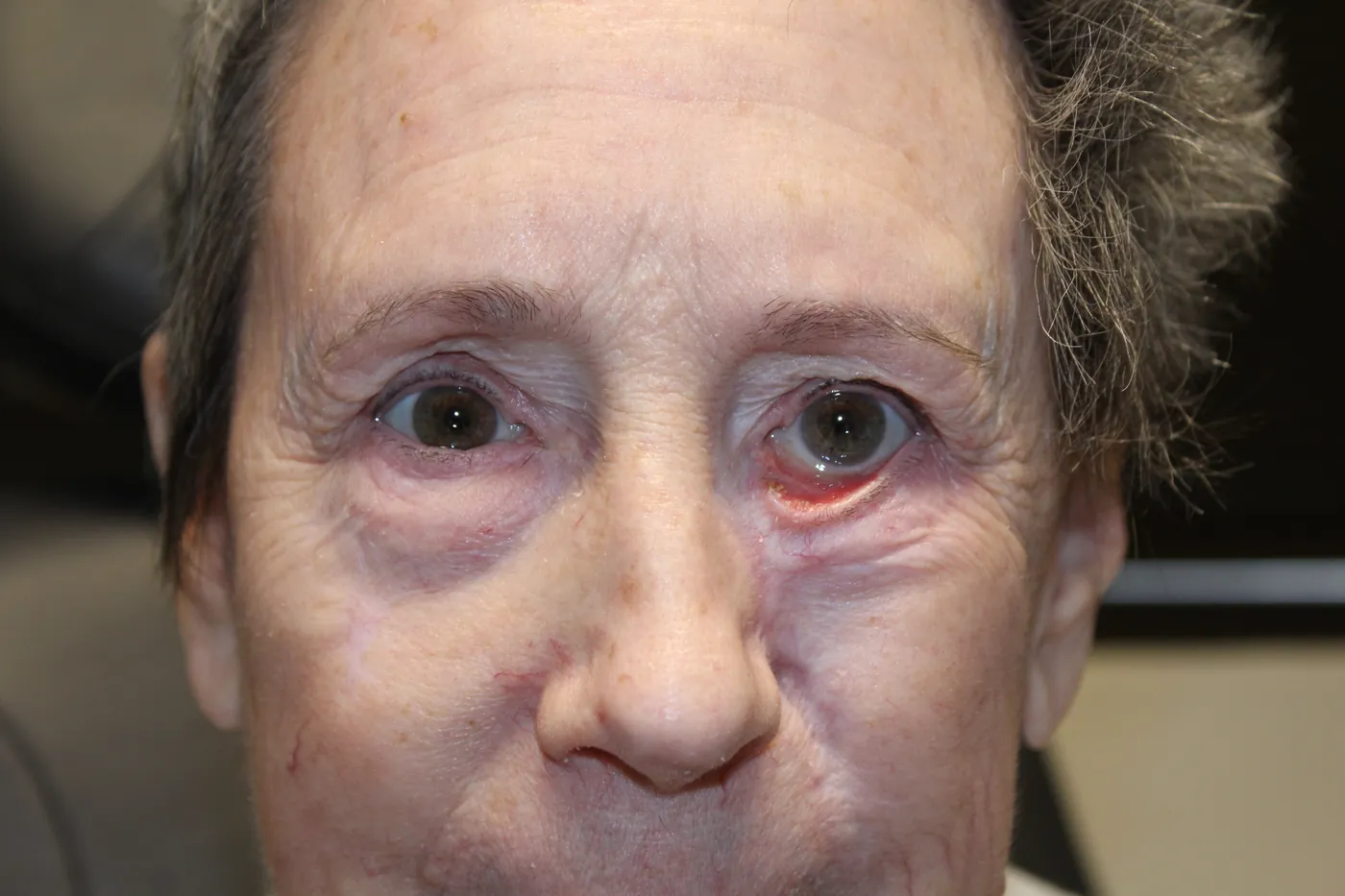 Before Left Lower Eyelid Reconstruction — patient photo