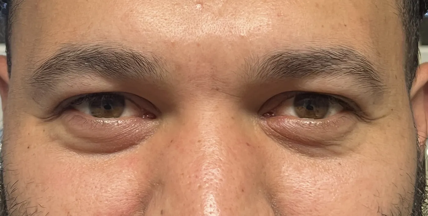 After Traumatic Lacerations to the Eyelid and Tear Duct — patient photo