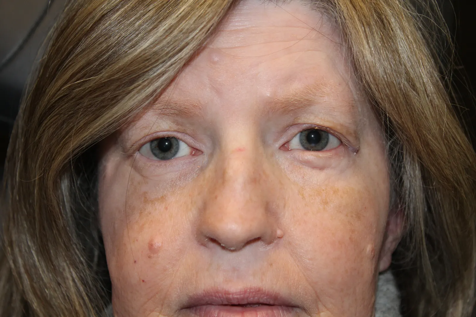 After Lower Lid Retraction Repair — patient photo