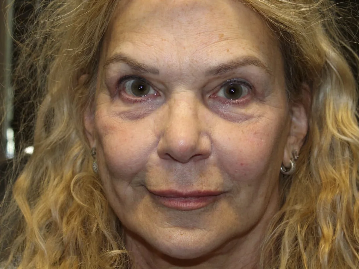 After Brow Lift · Upper Blepharoplasty — patient of Dr. Ahmed Sheikh, Morristown NJ