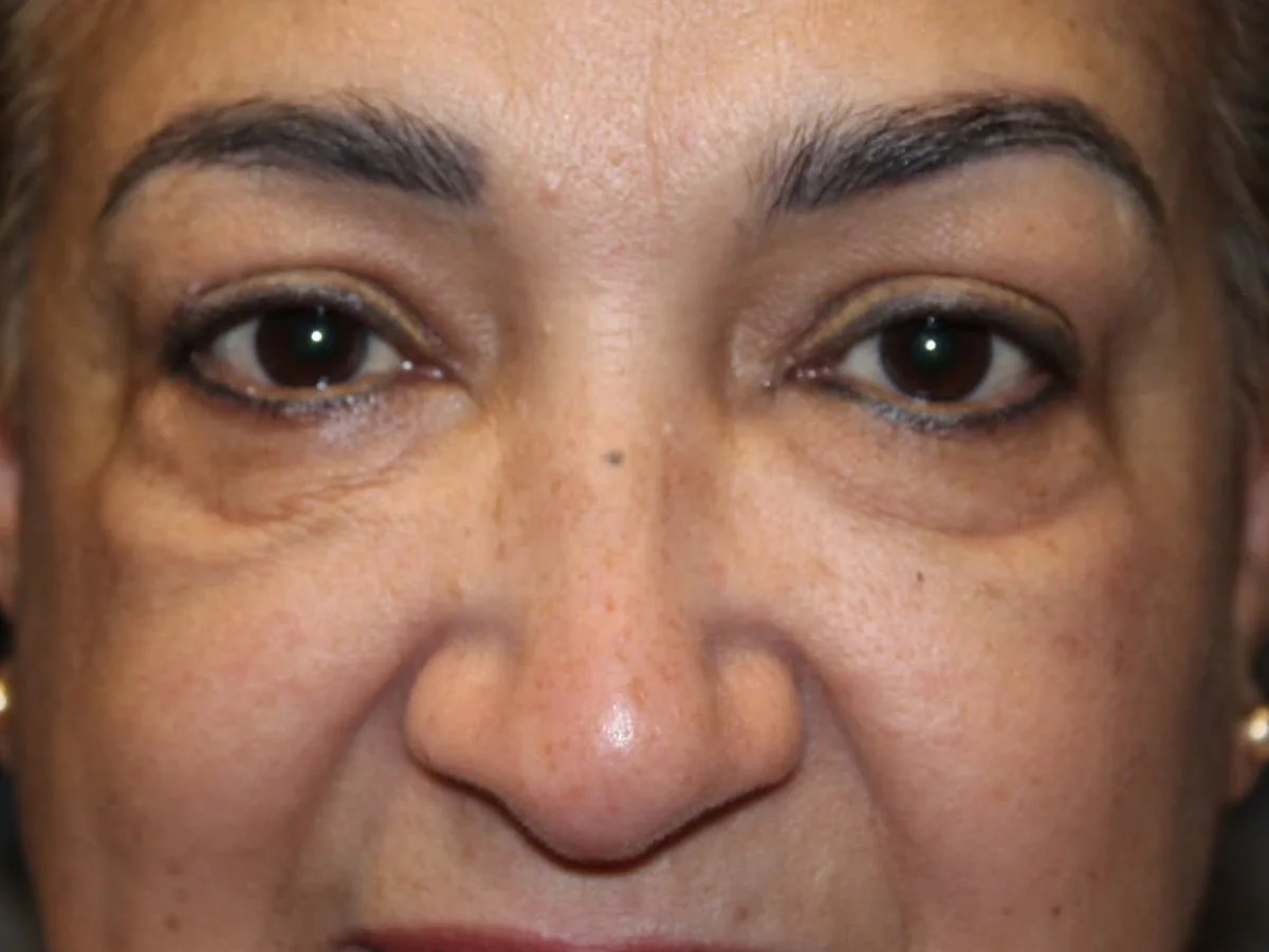 Before Upper Blepharoplasty · Lower Blepharoplasty — patient of Dr. Ahmed Sheikh, Morristown NJ