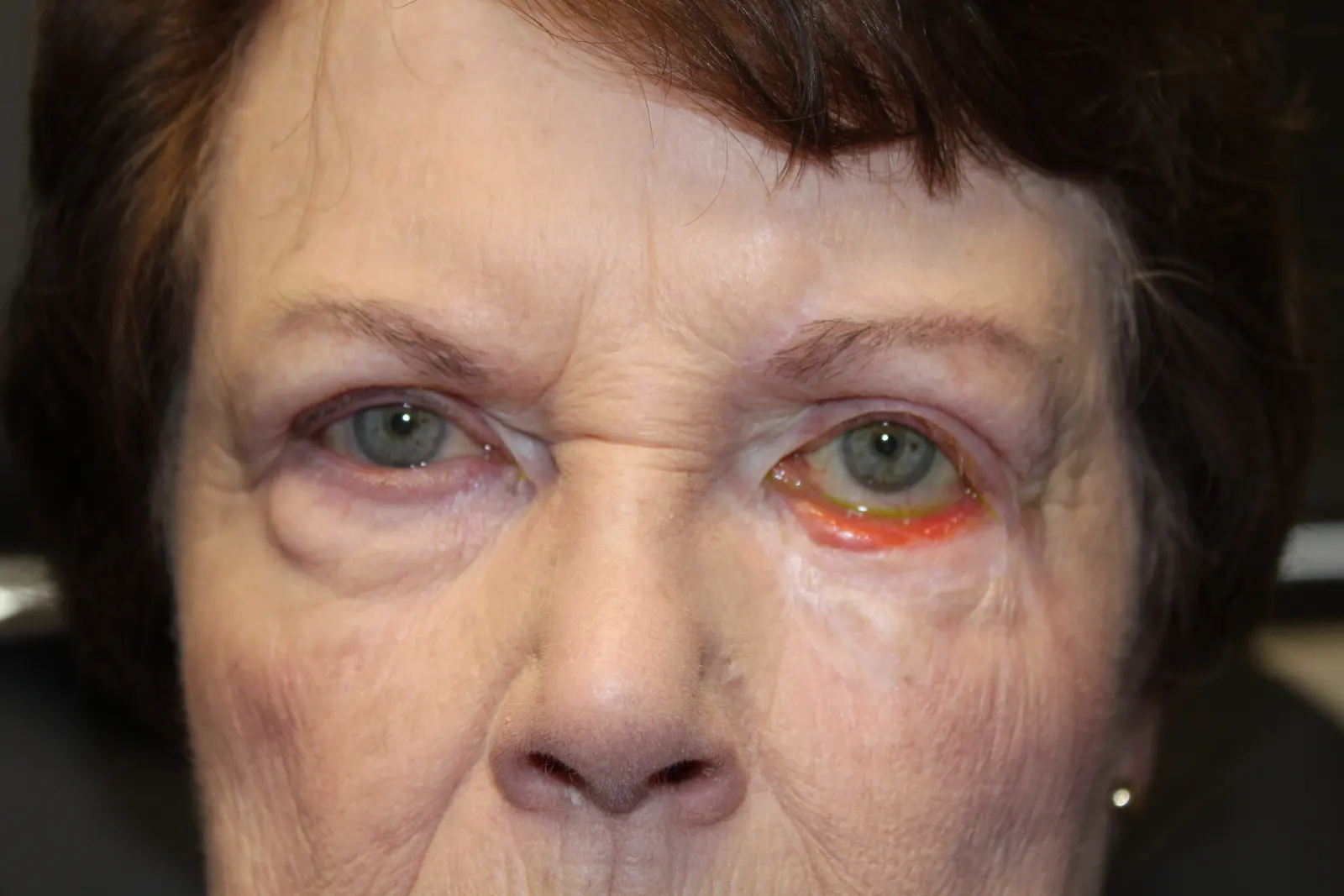 Before Left Lower Eyelid Reconstruction — patient photo