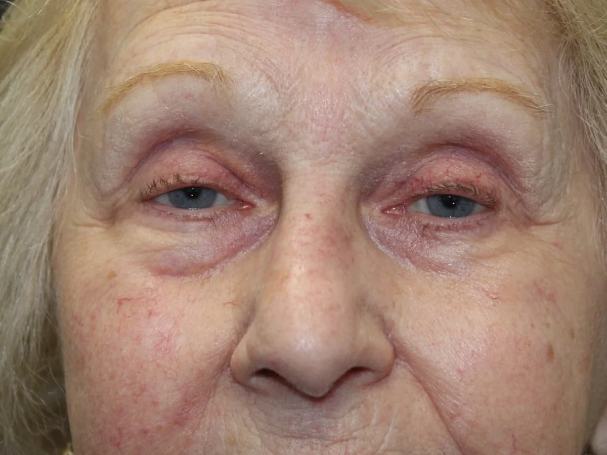 Before Ptosis Repair — patient of Dr. Ahmed Sheikh, Morristown NJ