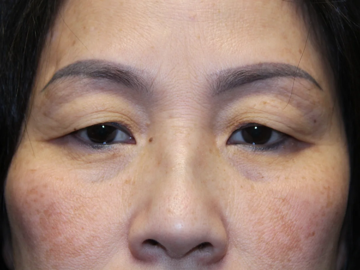 Before Upper Blepharoplasty — patient of Dr. Ahmed Sheikh, Morristown NJ