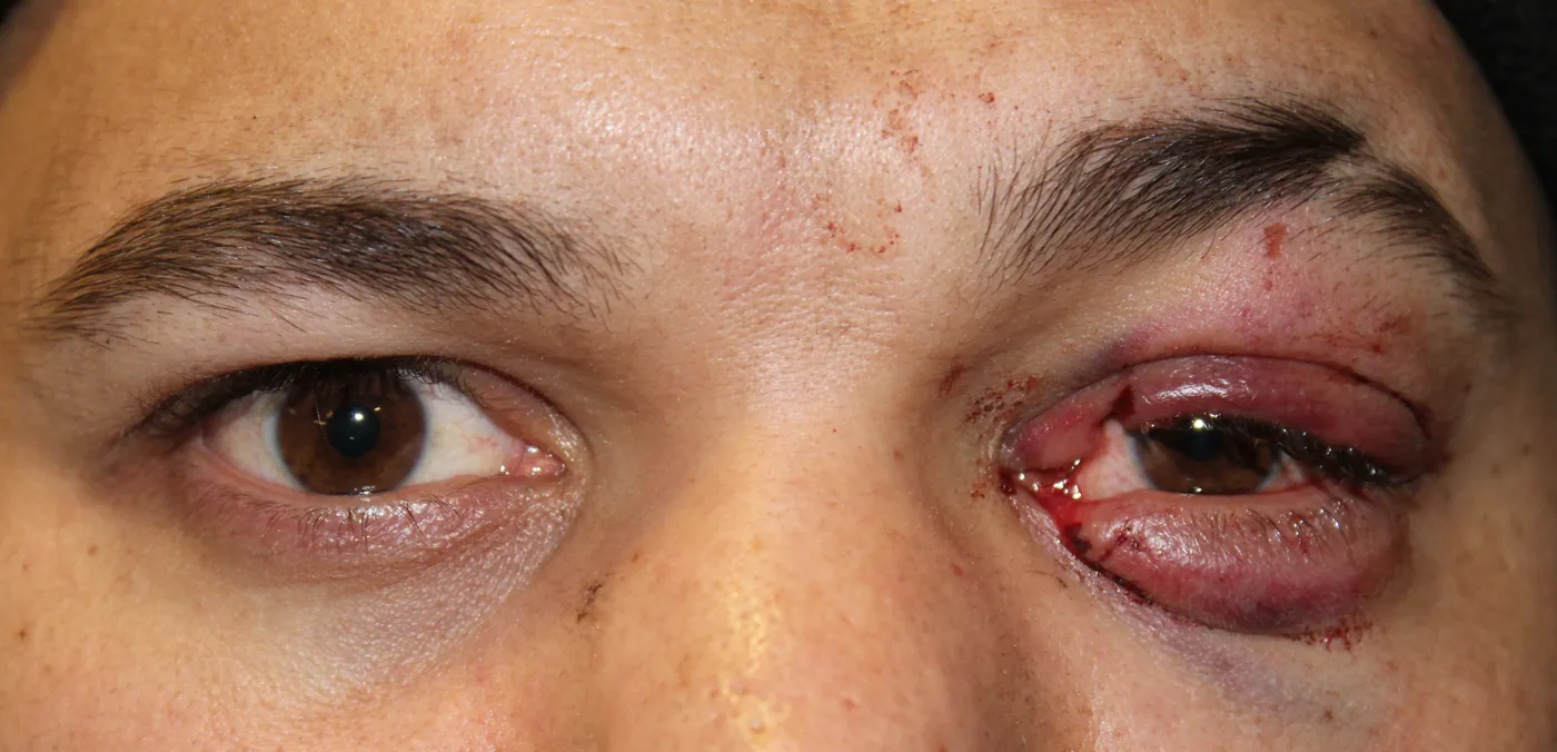 Before Traumatic Lacerations to the Eyelid and Tear Duct — patient photo