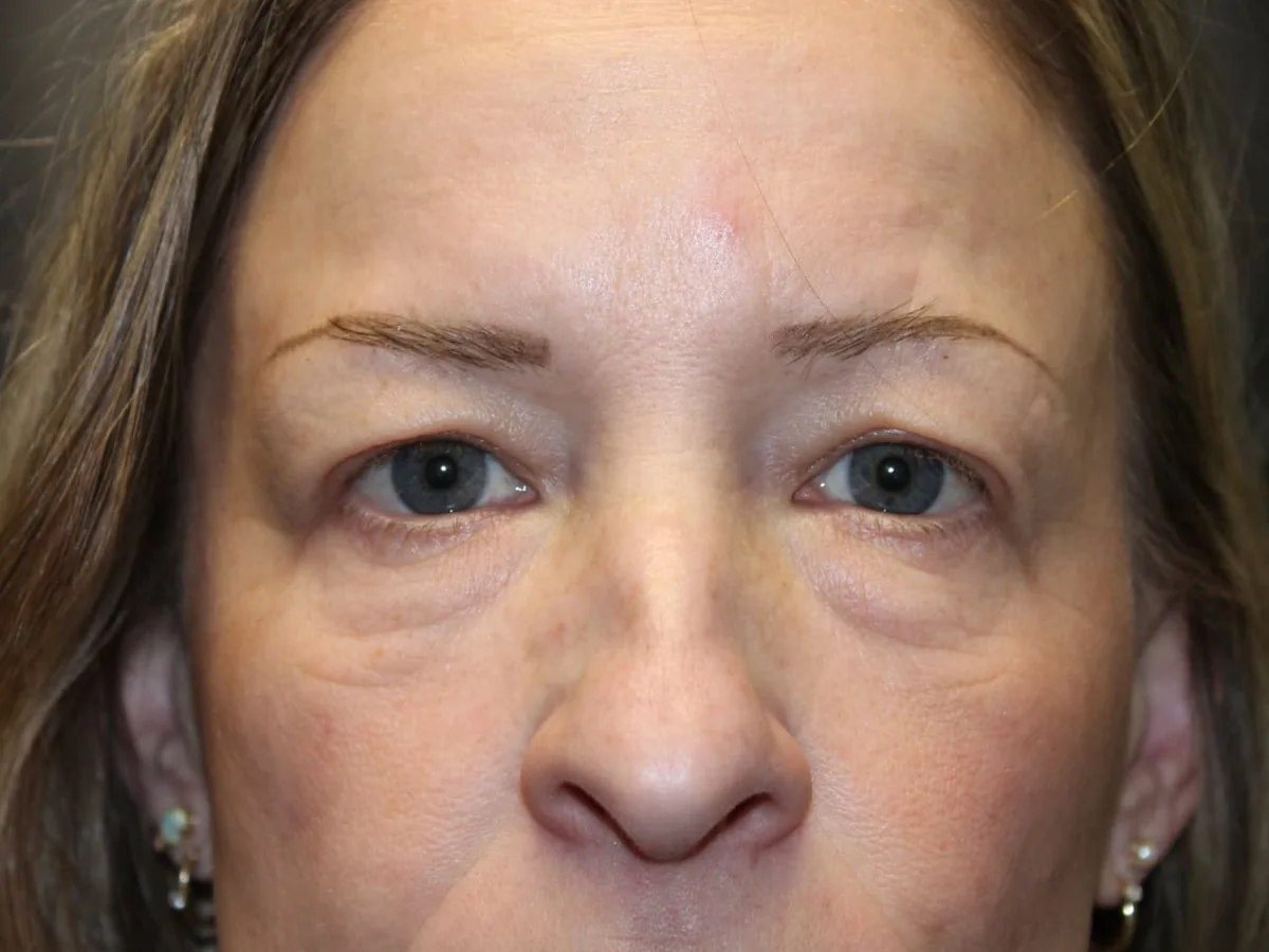 Before Upper and Lower Blepharoplasty — patient photo