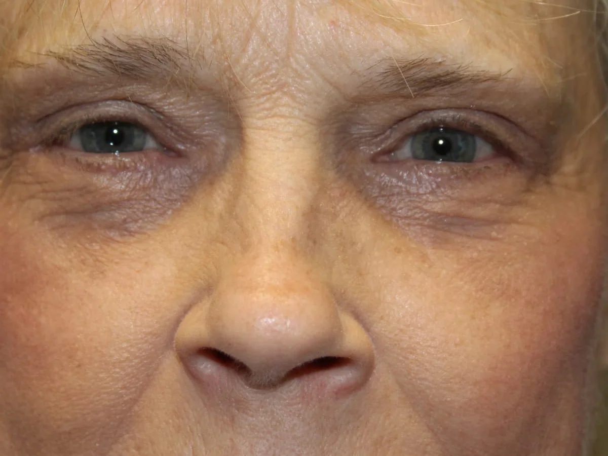 After Upper Blepharoplasty · Lower Blepharoplasty — patient of Dr. Ahmed Sheikh, Morristown NJ