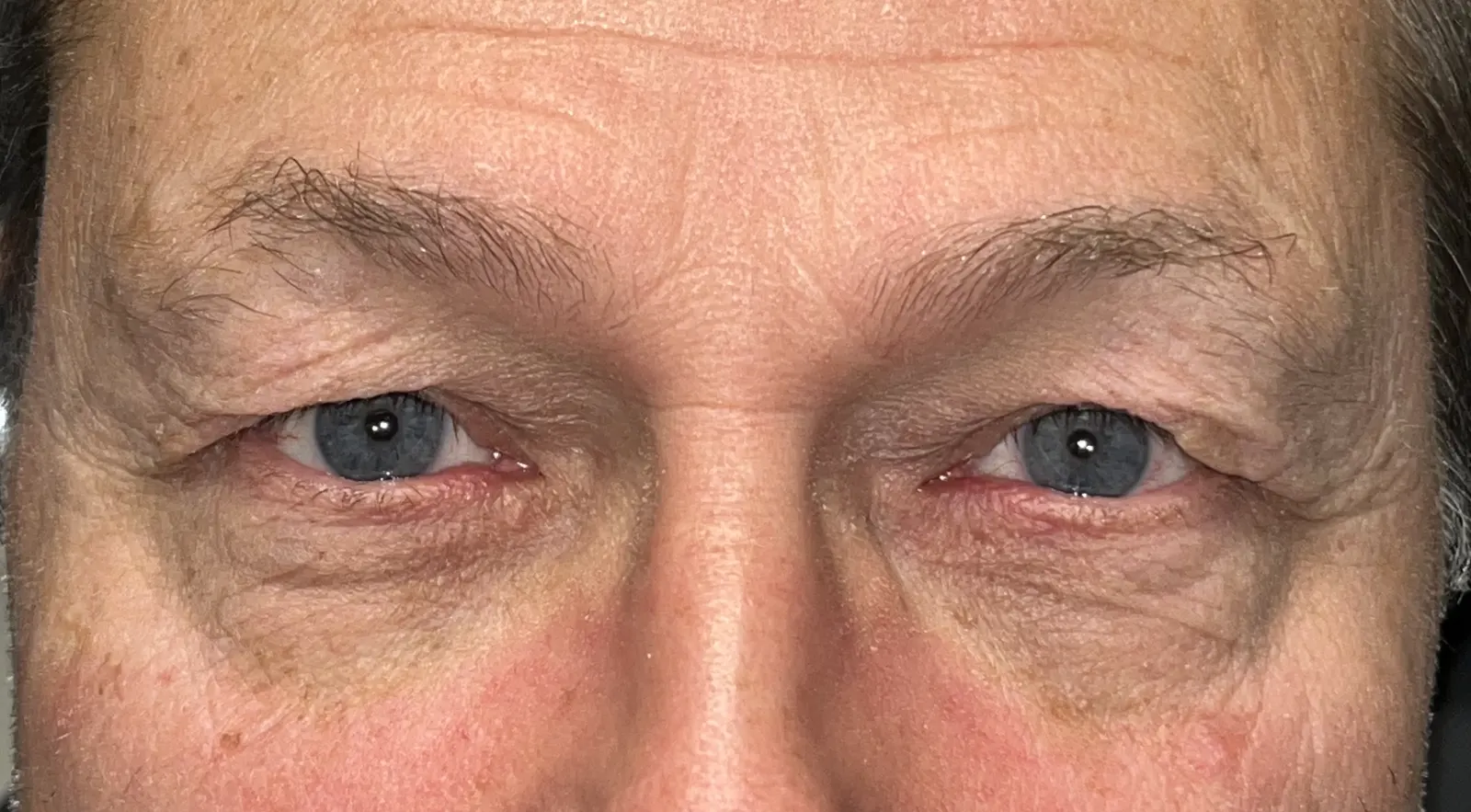 Before Upper Blepharoplasty — patient photo