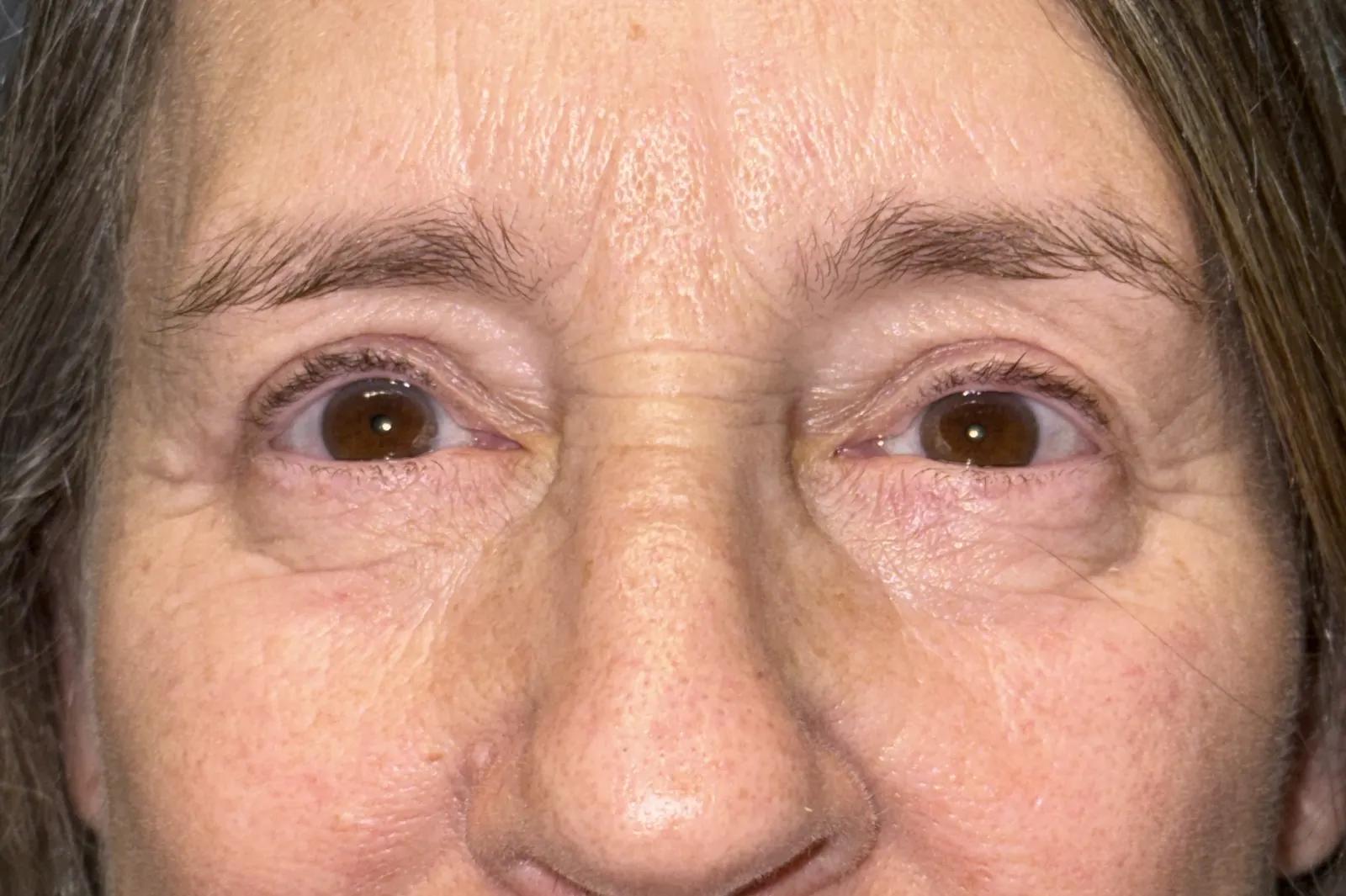 After Upper Blepharoplasty · Ptosis Repair — patient photo
