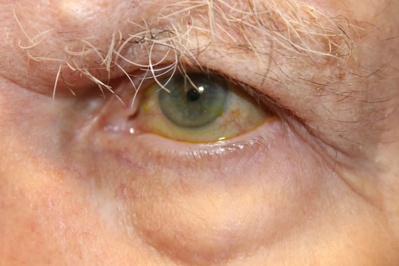 Before Correction of a Paralyzed Lower Eyelid Using a Tendon Graft — patient photo