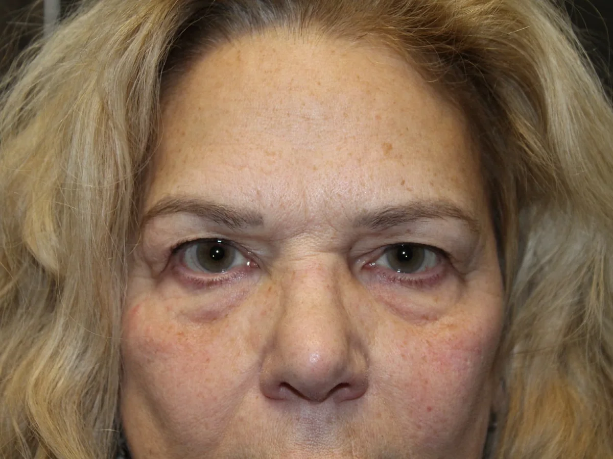 Before Brow Lift · Upper Blepharoplasty — patient of Dr. Ahmed Sheikh, Morristown NJ