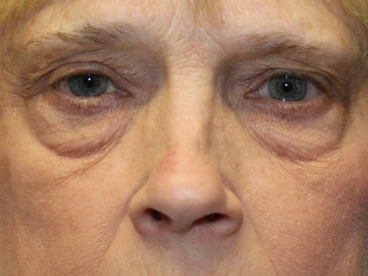 Before Upper Blepharoplasty · Lower Blepharoplasty — patient of Dr. Ahmed Sheikh, Morristown NJ
