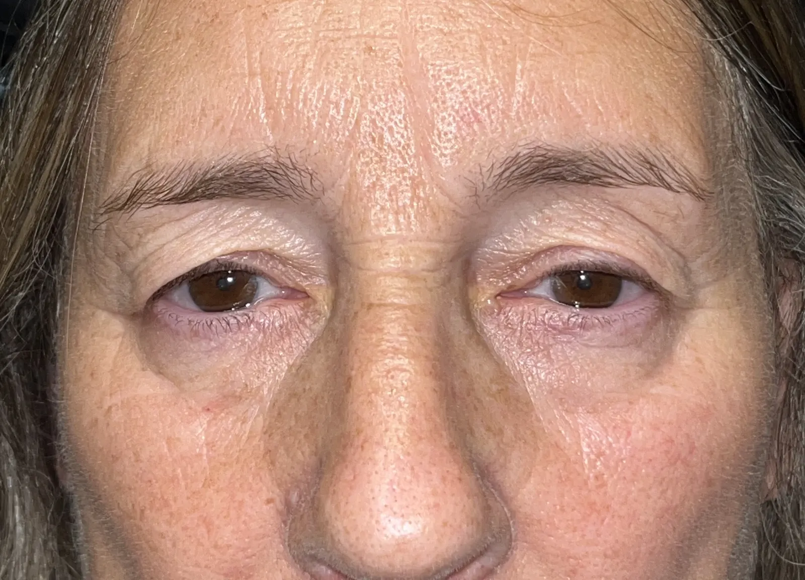 Before Upper Blepharoplasty · Ptosis Repair — patient photo