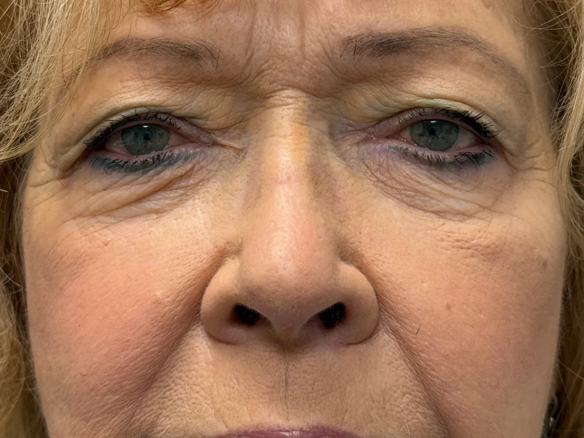 Before Upper Blepharoplasty · Brow Lift — patient of Dr. Ahmed Sheikh, Morristown NJ