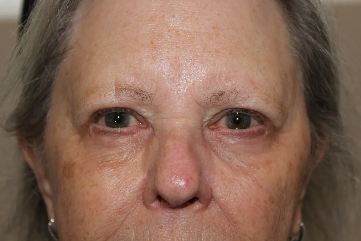 After Lateral Brow Lift · Upper Blepharoplasty · Ptosis Repair · Lower Blepharoplasty — patient photo